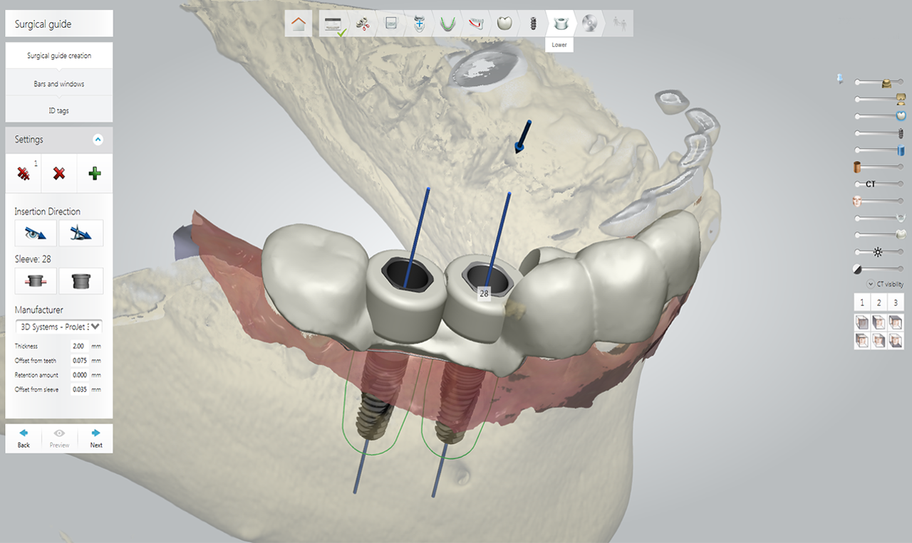 digital implantology