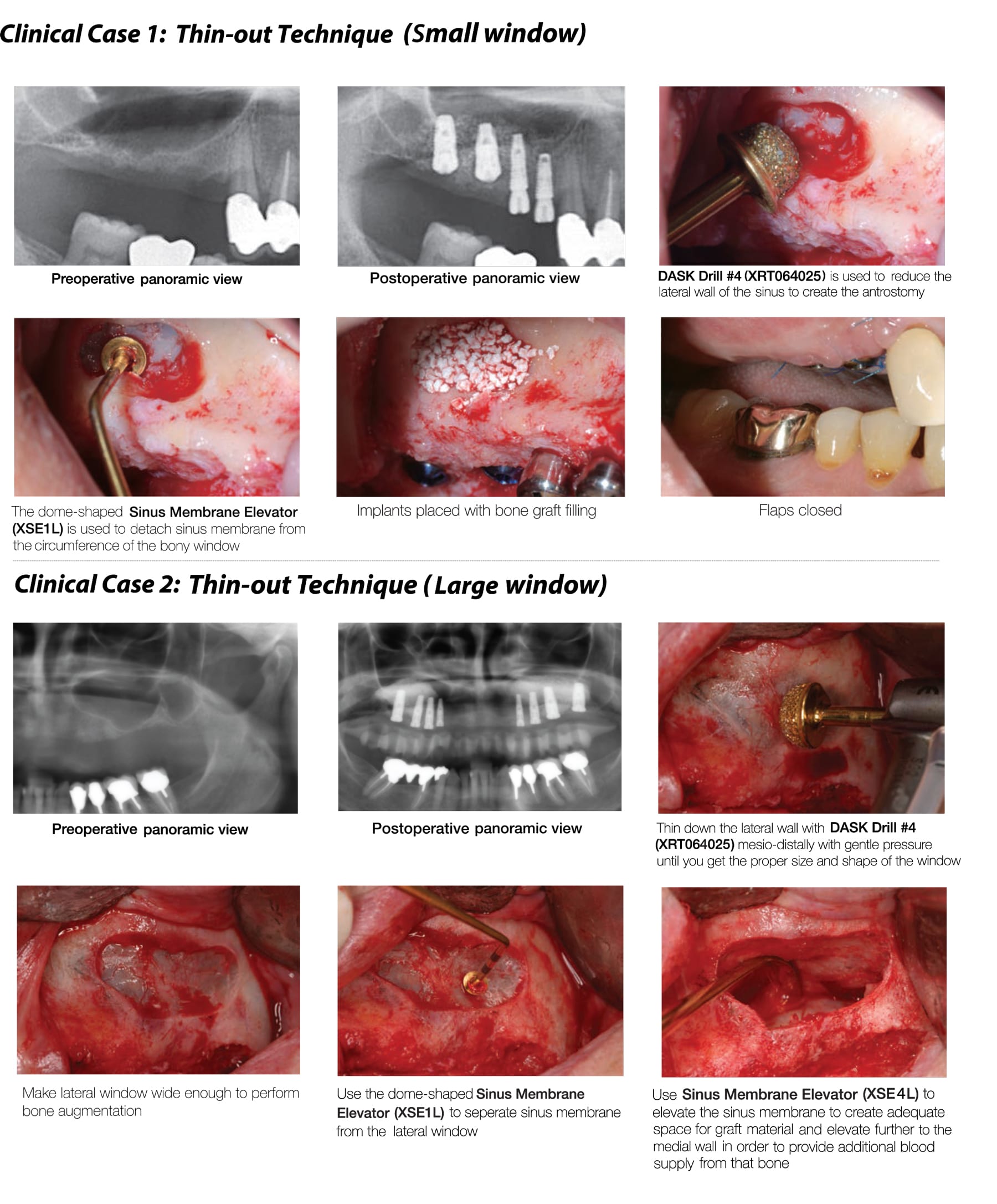 Dentium Advanced Sinus Kit - DASK