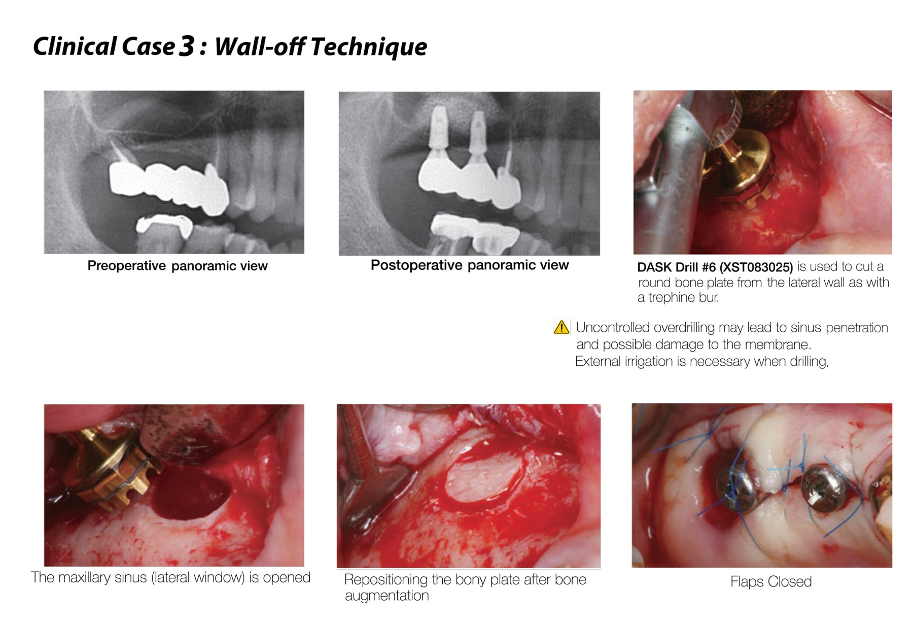 Dentium Advanced Sinus Kit - DASK