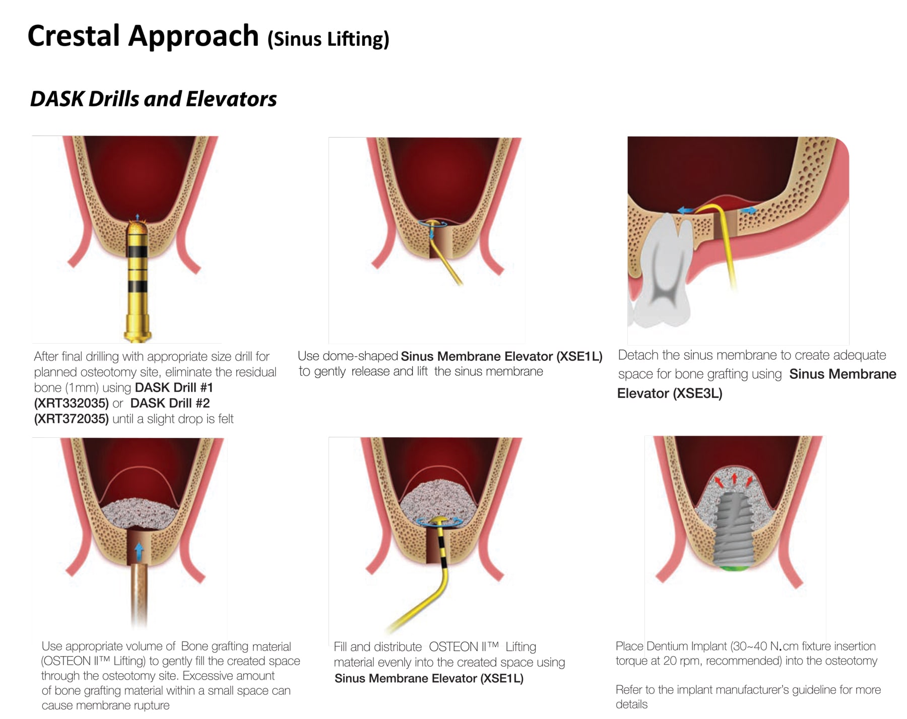 Dentium Advanced Sinus Kit - DASK