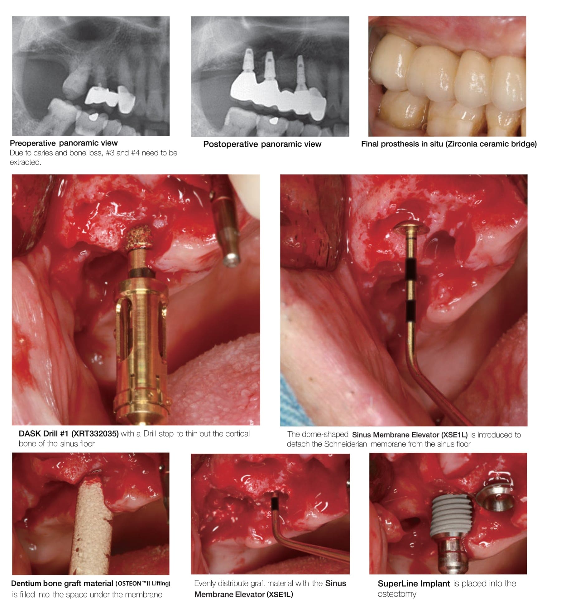 Dentium Advanced Sinus Kit - DASK