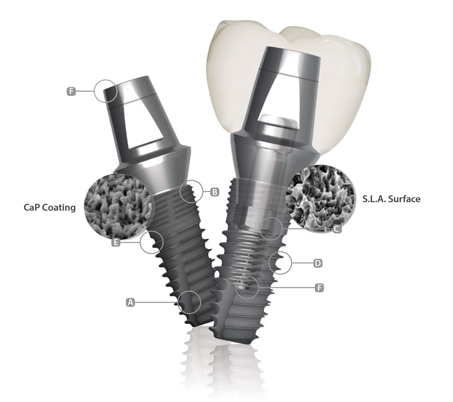 implantium ii fixture features