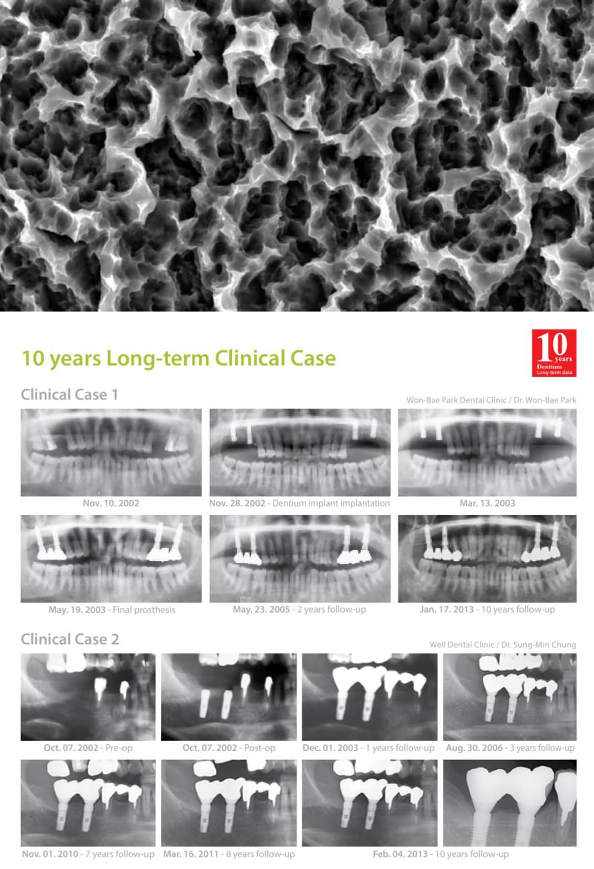 Dentium NR Line SLA Surface