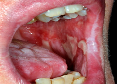 Crohn's mouth ulcers