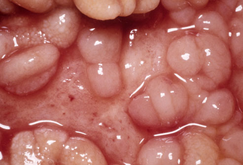 Crohn's mouth ulcers