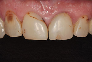 veneer composite