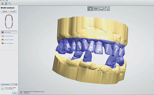 dentures