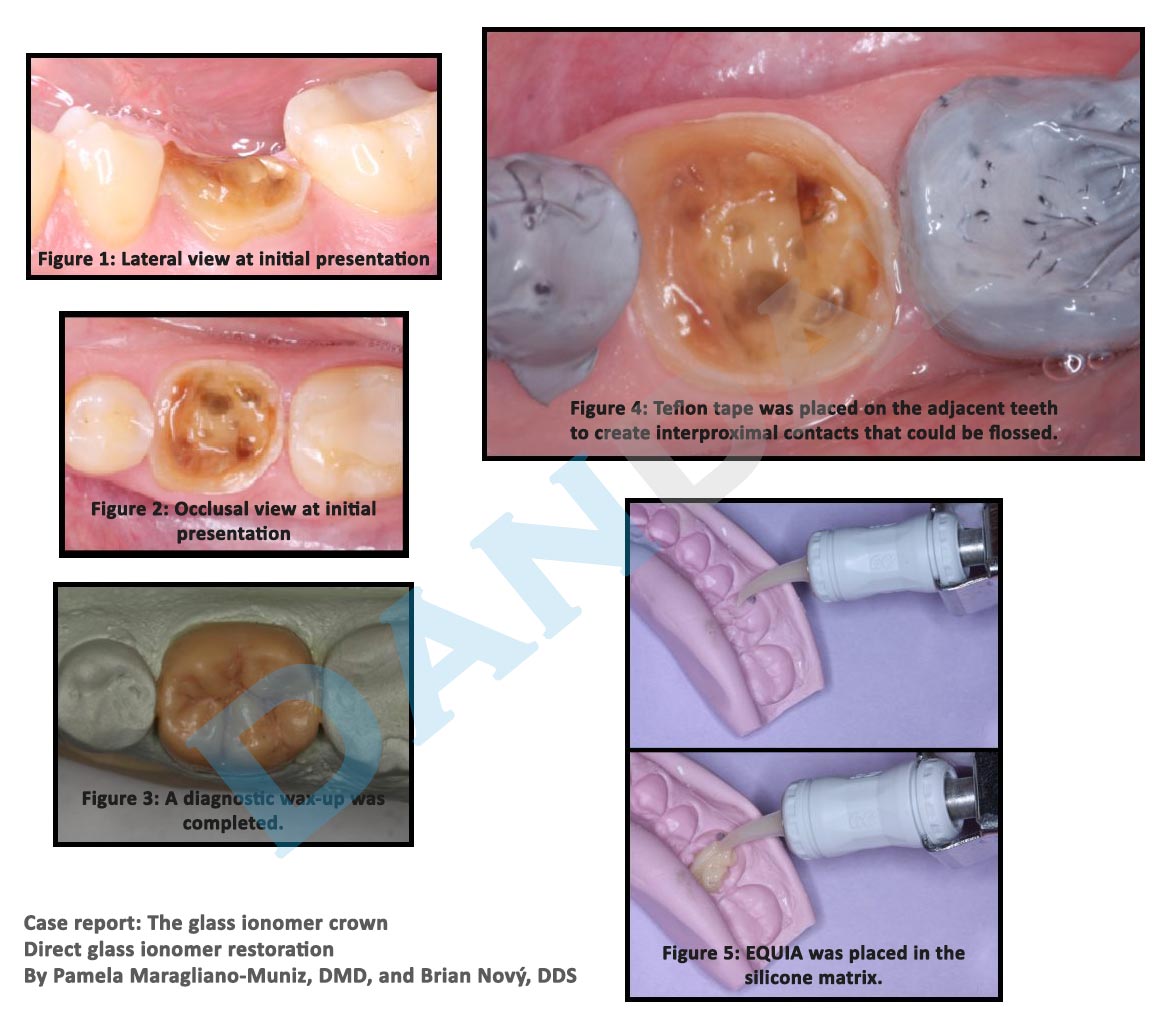 glass ionomer