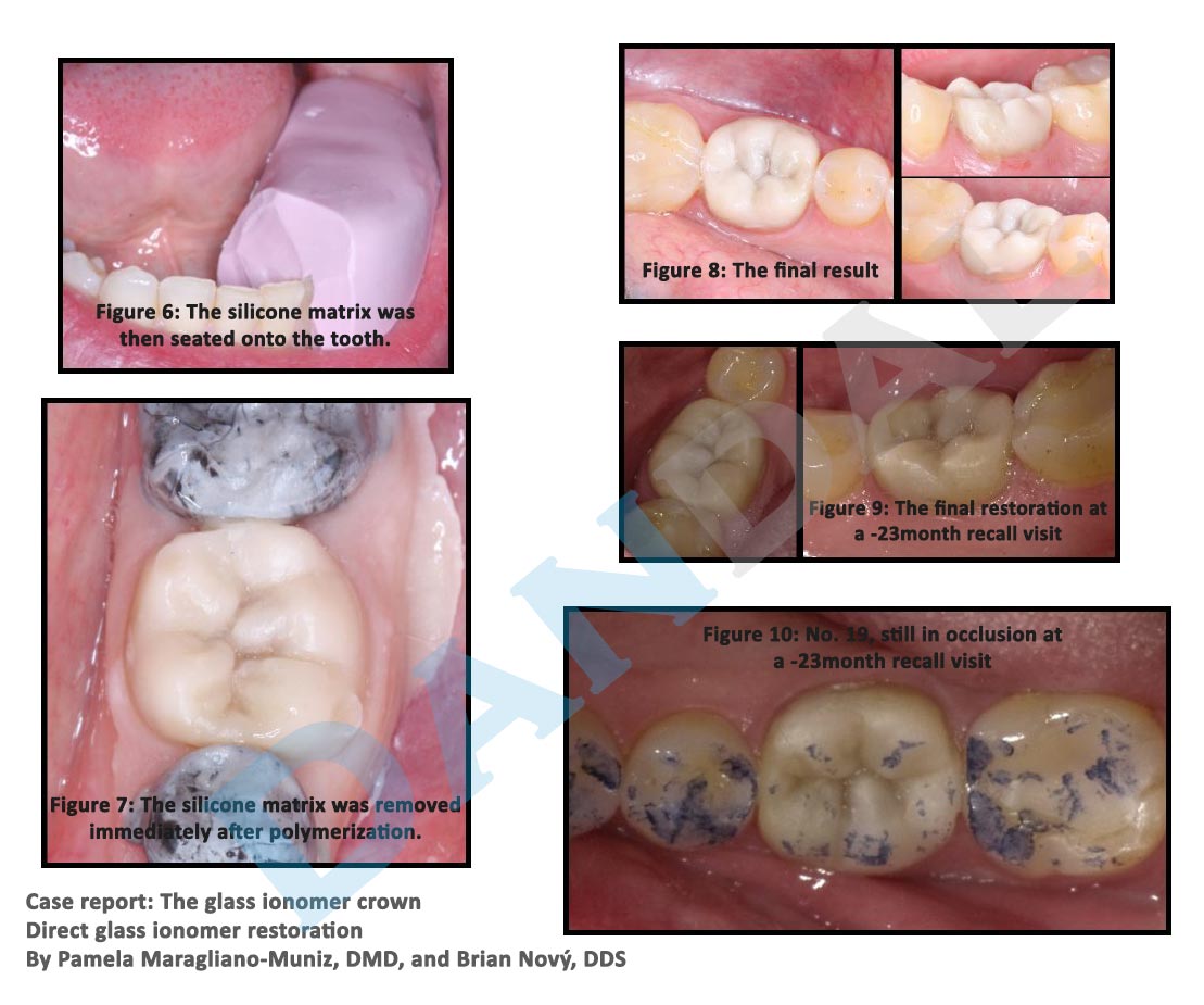 glass ionomer2