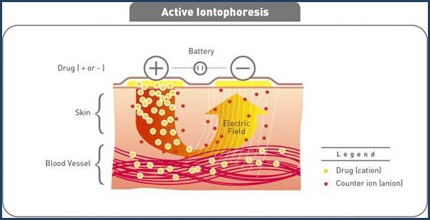 iontophoresis