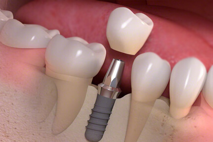 implant maintenance