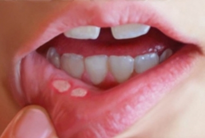 از زخم های دهانی کرون چه میدانید؟