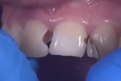 Art restoration of anterior teeth