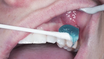 ژل بی‌حسی، راه حلی ساده برای مقابله با فوبیای دندانپزشکی!