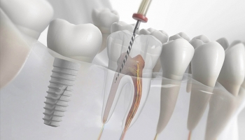 اندو یا ایمپلنت، کدام طرح درمان؟