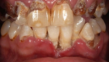 The Destructive Impact of Methamphetamine on Oral Health