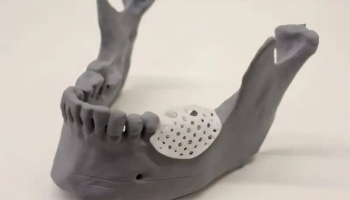 Revolutionizing Jawbone Reconstruction with 3D Printing Technology