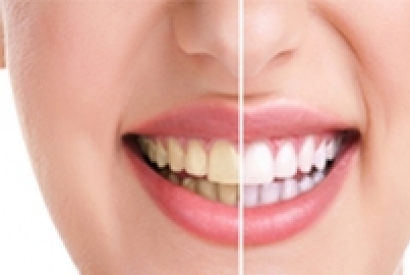 بهترین راه حل برای سفید کردن دندان ها
