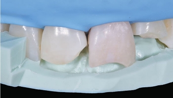 ویدئو راهنمای استفاده از سیلیکون ایندکس برای ترمیم دندان قدامی